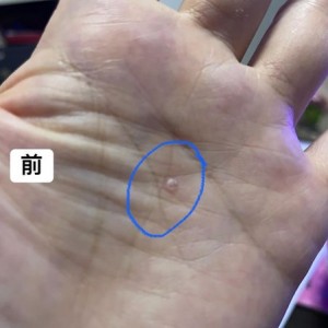 手掌長一粒東西